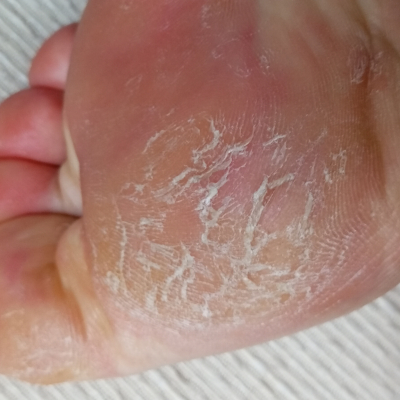 Erkrankung Haut Fußsohle